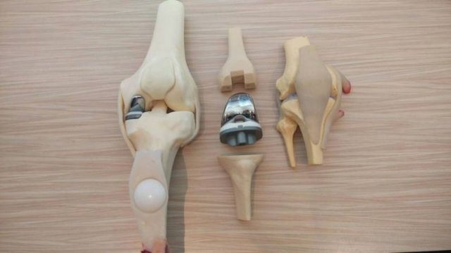 Growing demand for orthopedic implants amid a global graying population is among main factors accelerating market expansion of medical alloys (photo courtesy of UDN.com).