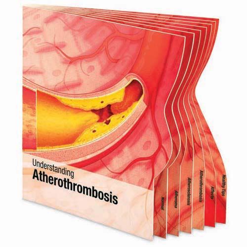 Lenticular Board Book (Understanding Atherothrombosis) Lenticular Board Book (Understanding Atherothrombosis)
